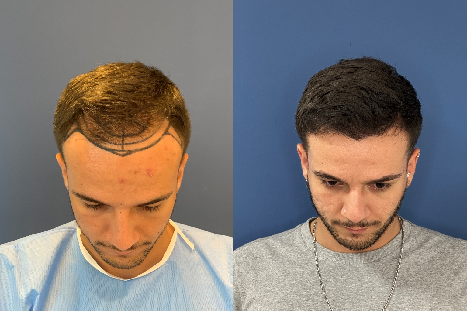 Antes e depois de transplante capilar, marcação da linha e resultado