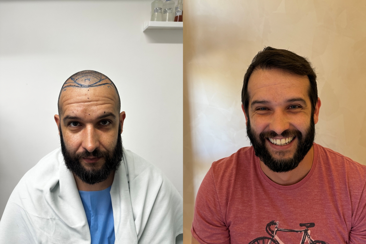 Antes e depois de transplante capilar, cobertura e densidade