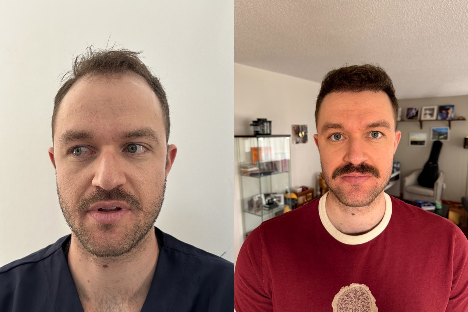 Antes e depois de transplante capilar, entrada e linha